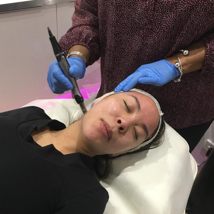 Microneedling vs. Dermal Needling: What's the Difference?
