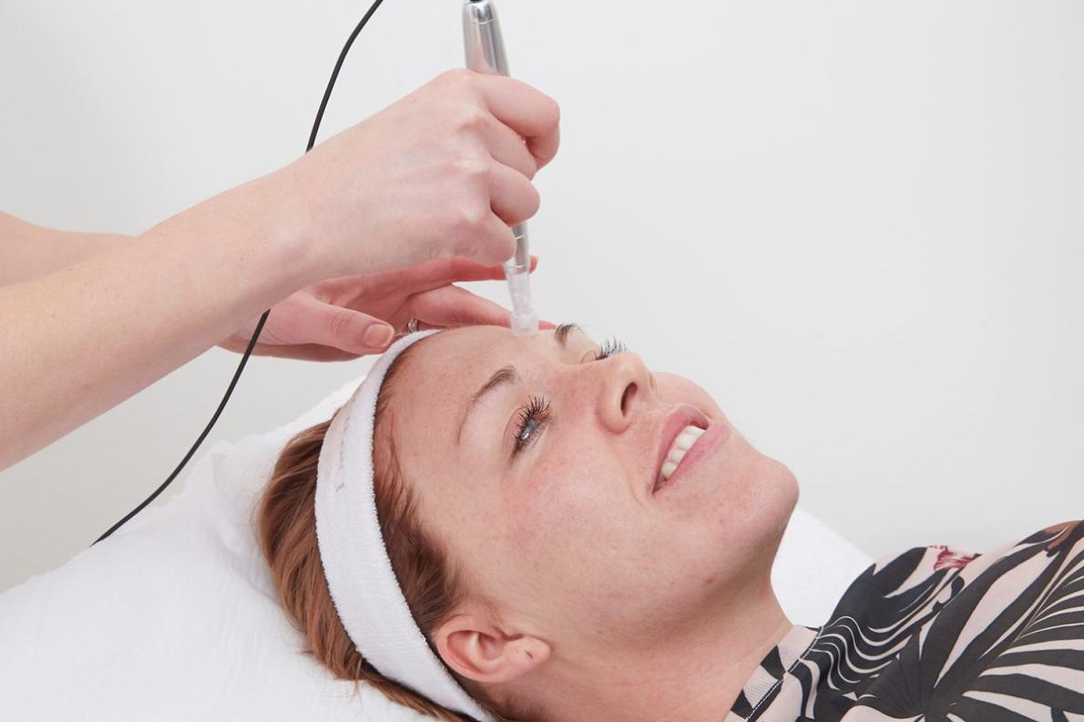 What Are Some Alternatives to Microneedling and Dermal Needling?