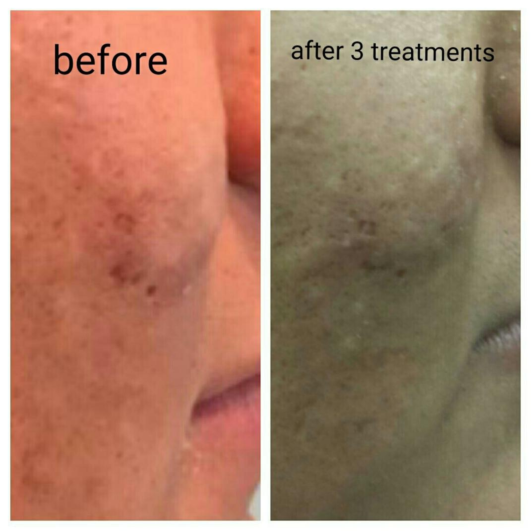 Are There Any Side Effects Associated with Microneedling Collagen Induction Therapy?