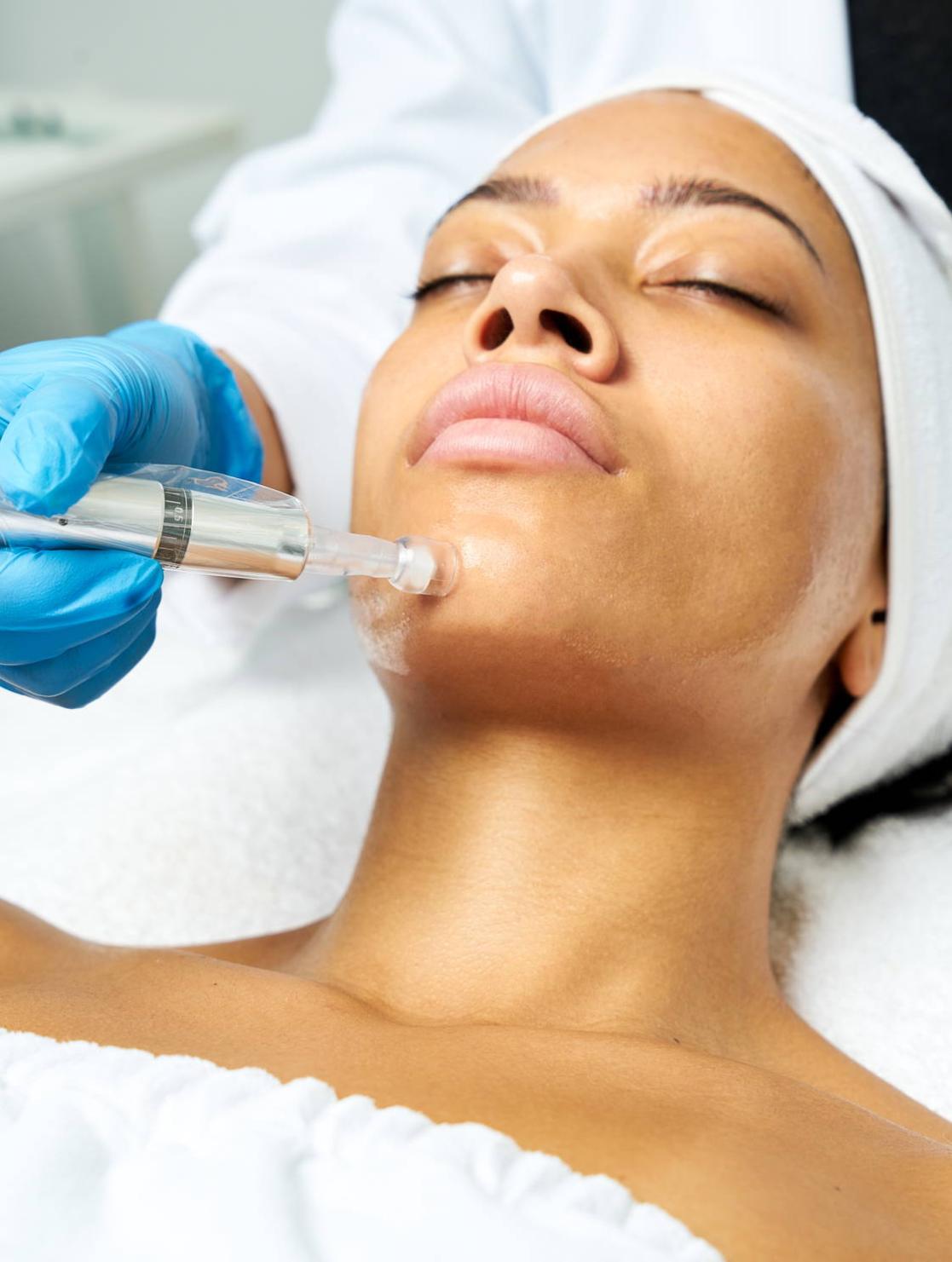 How Long Does It Take to See Results from Microneedling?