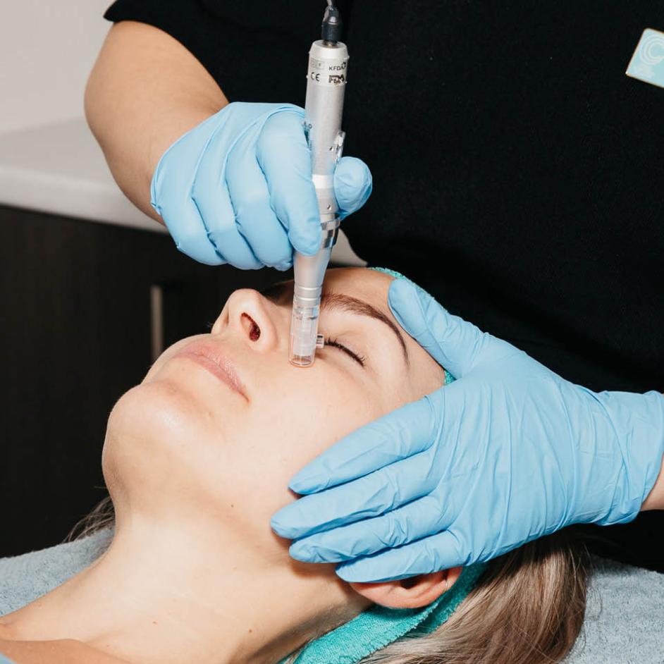 Microneedling: A Business Executive's Guide to Achieving Flawless Skin