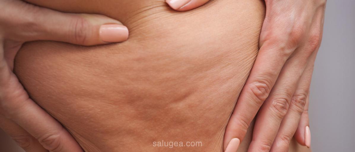 Personal What Is Cellulite? Care