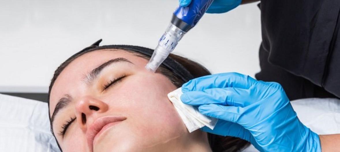 How Much Does Microneedling Collagen Induction Therapy Cost?