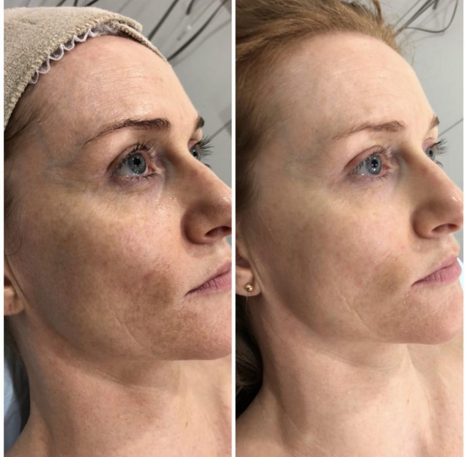 Who Is a Good Candidate for Microneedling Dermal Needling?