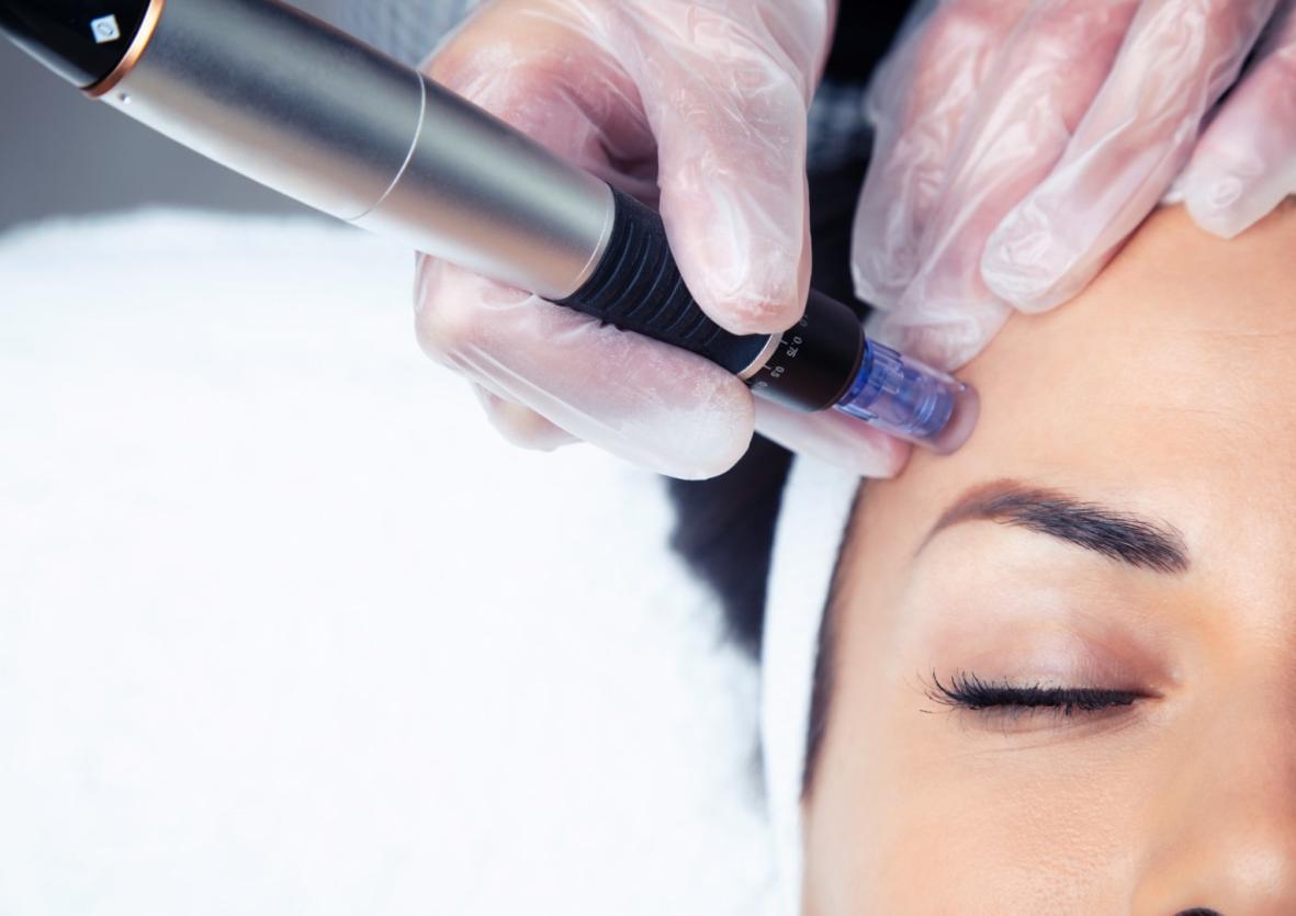 Microneedling vs. Botox: Which One Is Better for Wrinkles?